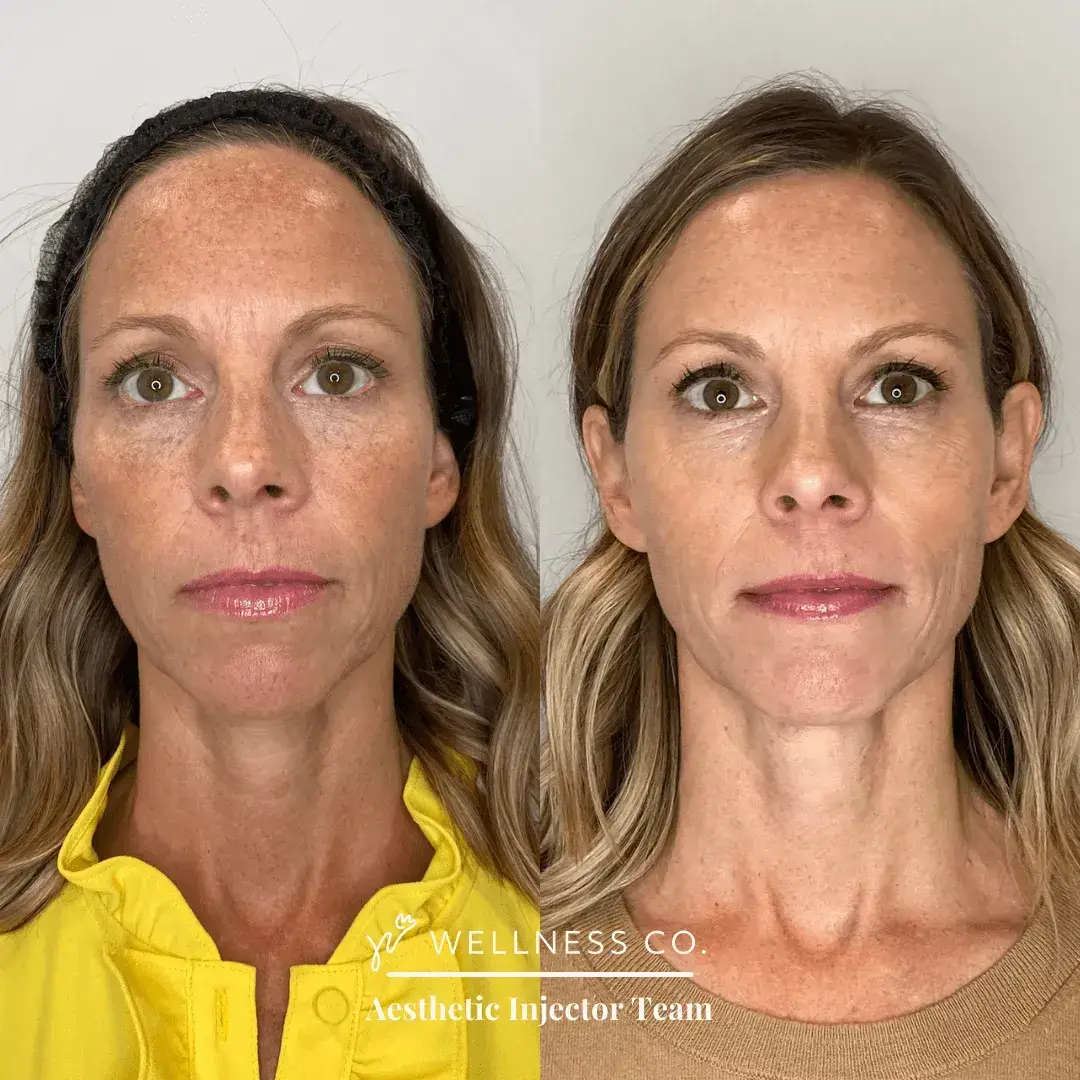 Before and After Photo | Sculptra | Wellness Co. | Zeeland, MI
