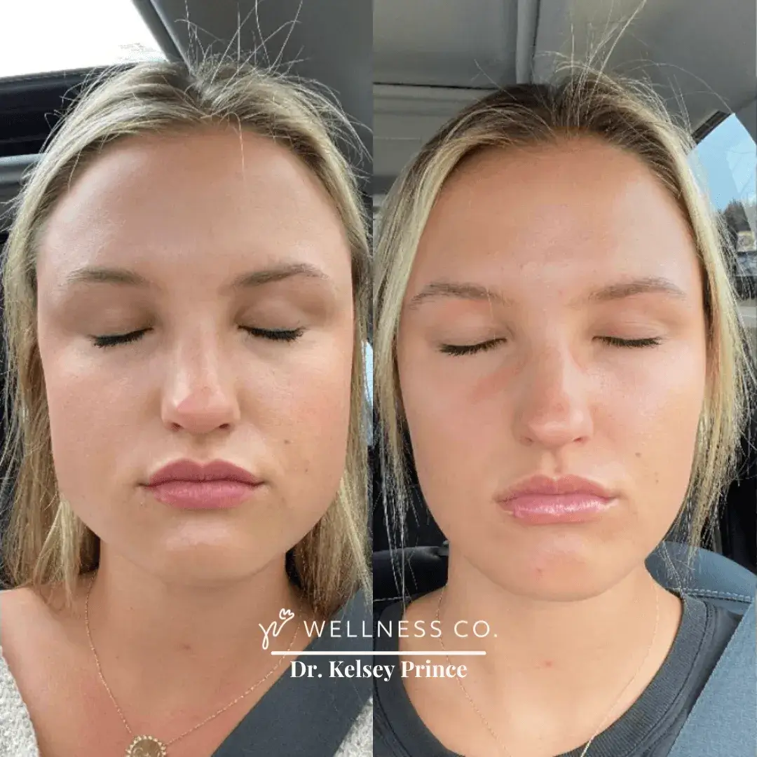 Before and After Photo | Botox treatment | Wellness Co. | Zeeland, MI
