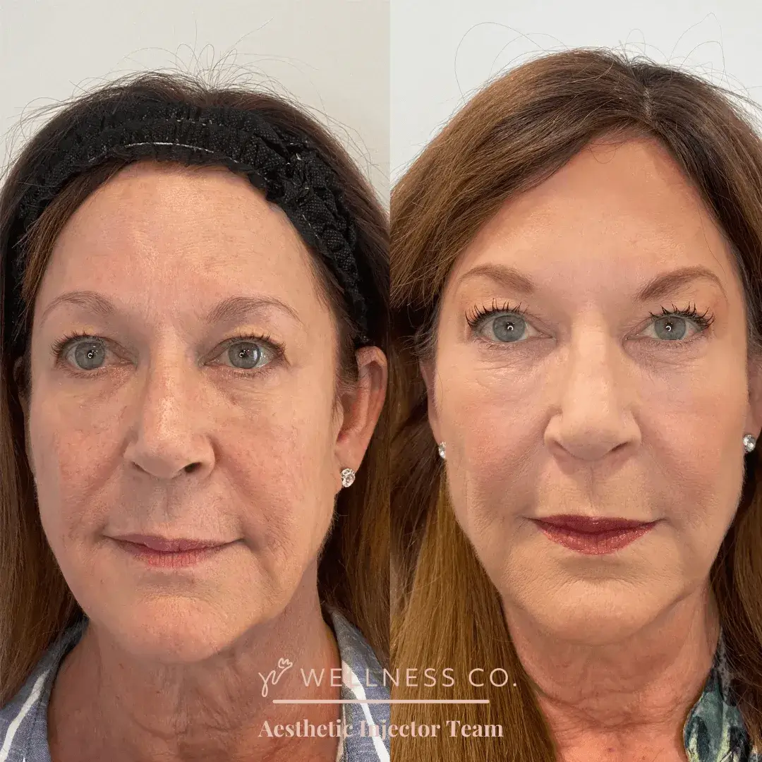 Before and after Photo | Sculptra for mid age woman | Wellness Co. | Zeeland, MI