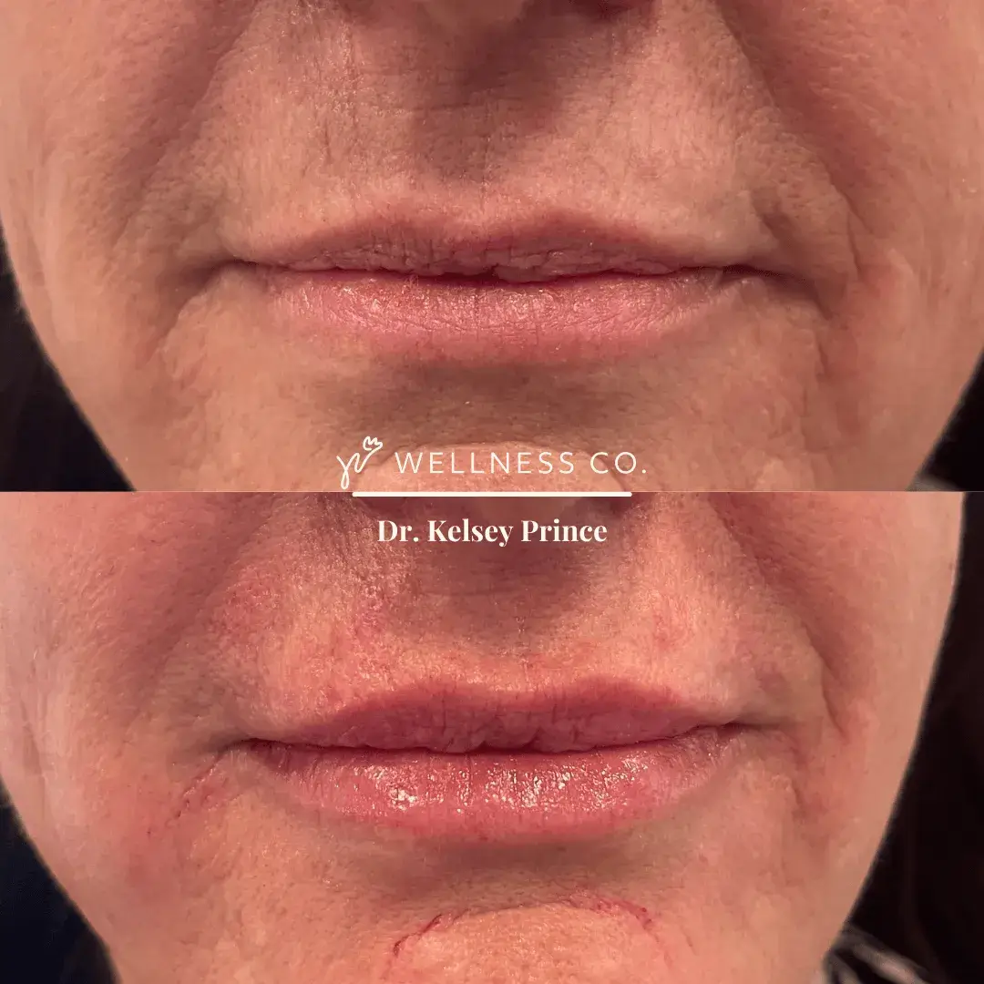 Before and after Photo | Dermal Filler | Lips | Wellness Co. | Zeeland, MI