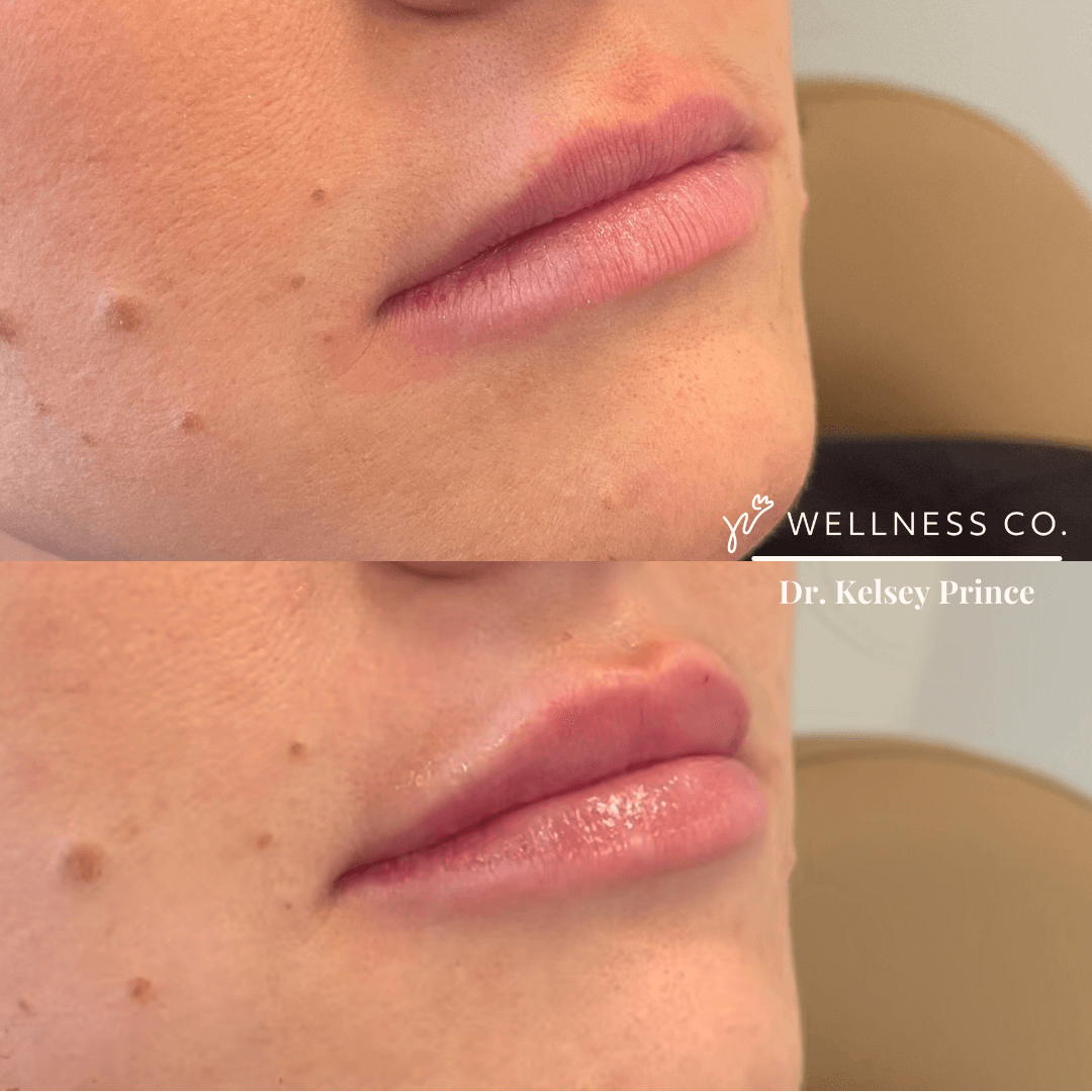 Before and after Photo | Dermal Filler | Lips | Wellness Co. | Zeeland, MI