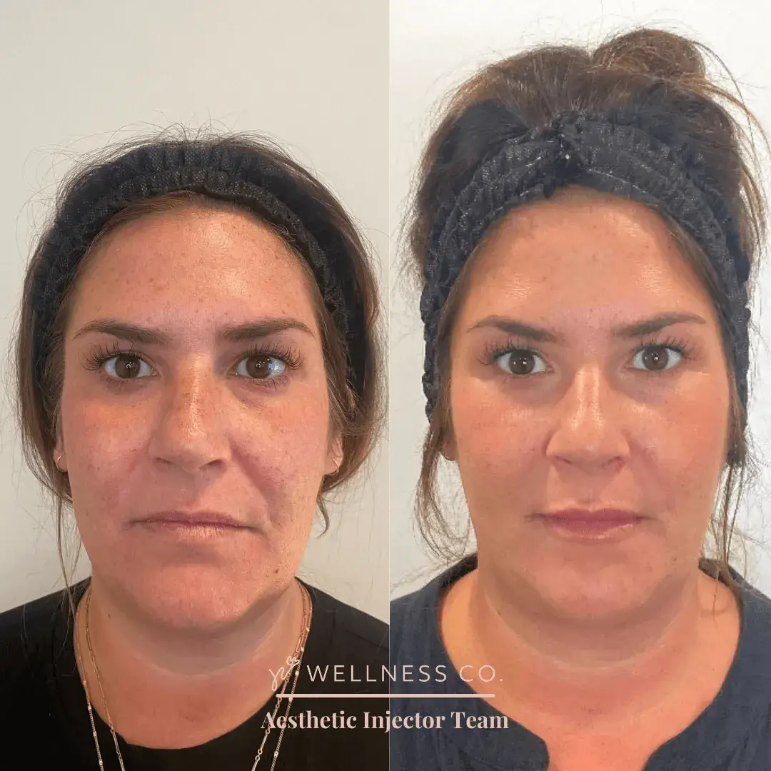 Before and after Photo | Dermal Filler | Woman Face | Wellness Co. | Zeeland, MI