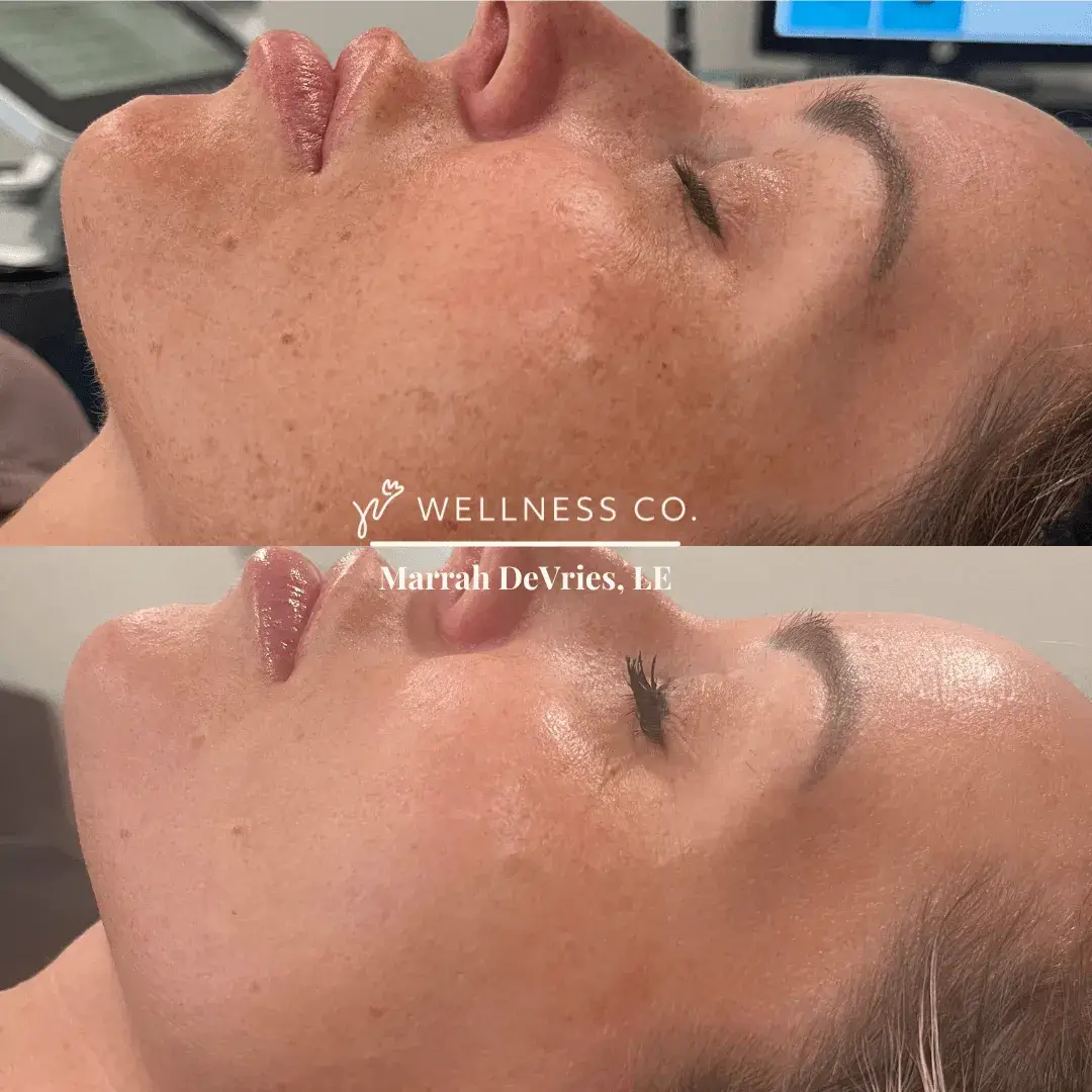 Before and After Photo | IPL | Wellness Co. | Zeeland, MI