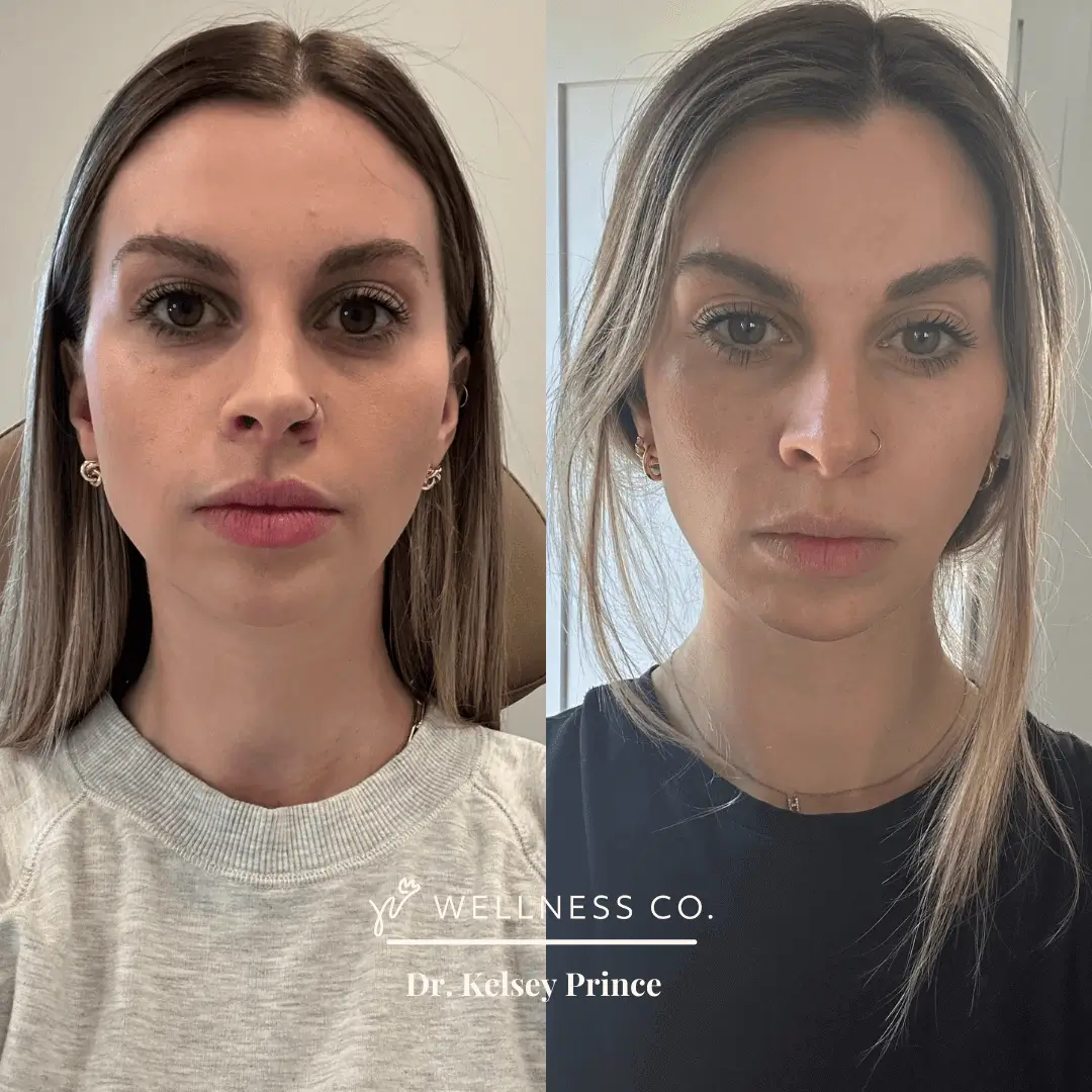 Before and After Photo | Botox for woman face | Wellness Co. | Zeeland, MI