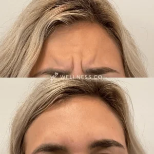 Before and After Photo | frown lines removal by Botox | Wellness Co. | Zeeland, MI