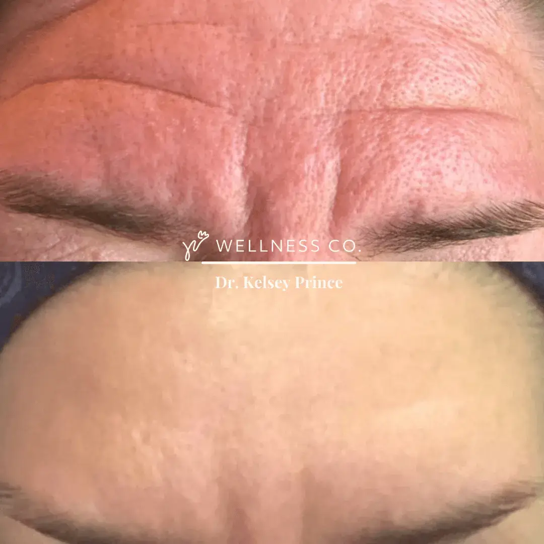 Before and After Photo | Botox for reducing frown lines | Wellness Co. | Zeeland, MI