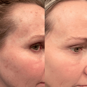 Before and after Photo | IPL for wrinkles | Wellness Co. | Zeeland, MI