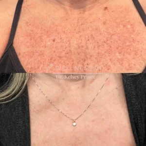Before and after Photo | IPL for chest | Wellness Co. | Zeeland, MI