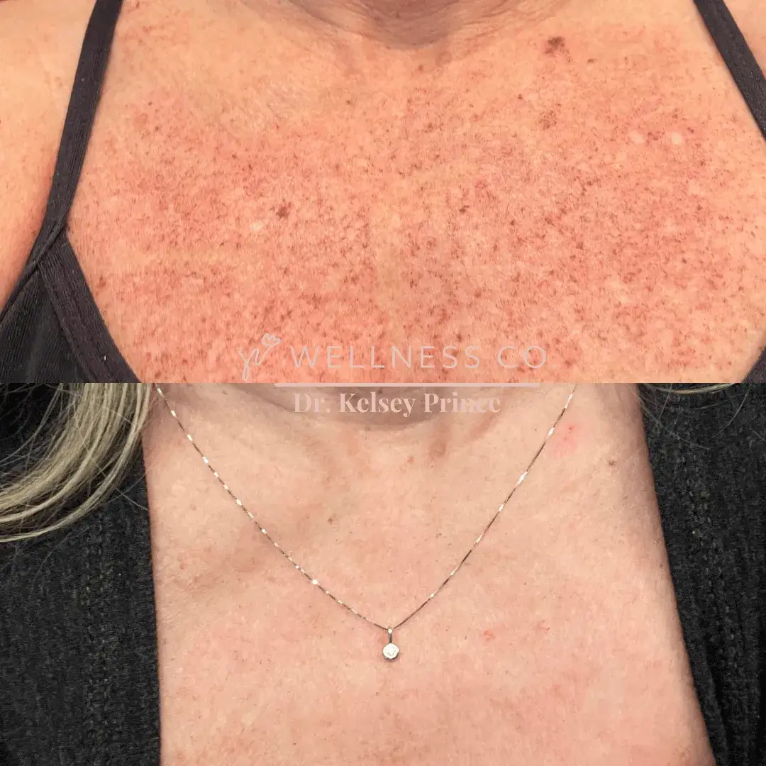 Before and after Photo | IPL for chest | Wellness Co. | Zeeland, MI