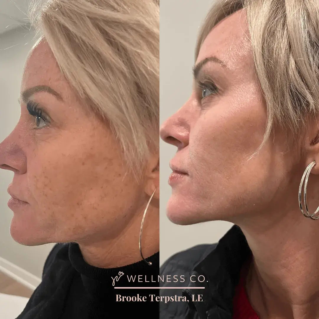 Before and after Photo | IPL Treatment for jawline | Wellness Co. | Zeeland, MI