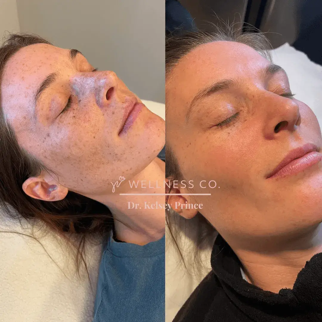Before and after Photo | IPL for face | Wellness Co. | Zeeland, MI