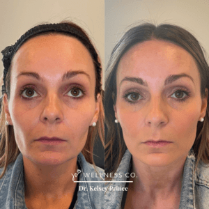 Before and After Photo | Aesthetic treatments | Wellness Co. | Zeeland, MI