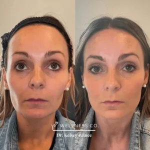 Before and After Photo | Aesthetic treatments | Wellness Co. | Zeeland, MI