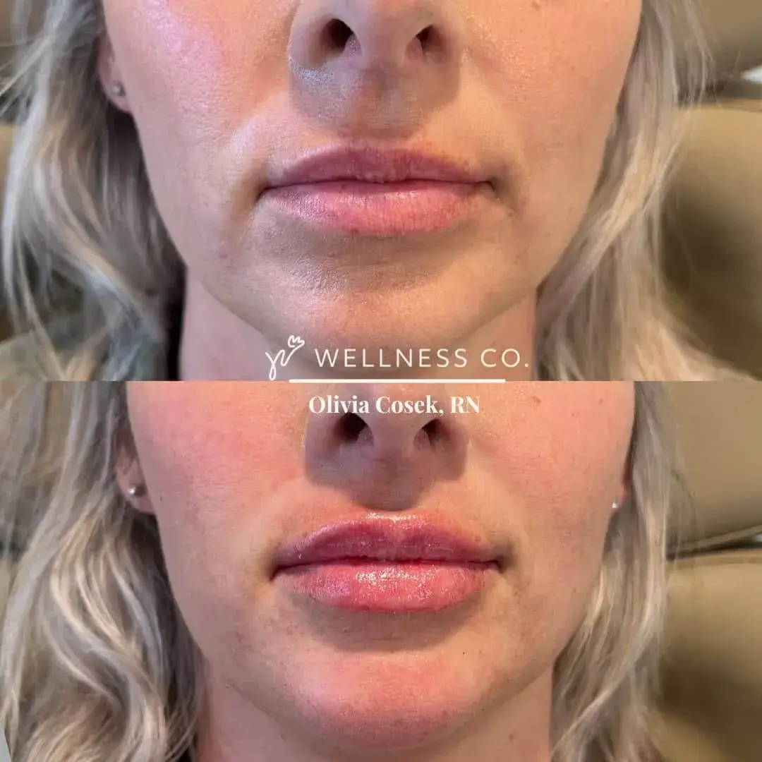 Before and After Photo | Filler treatment for enhanced lips | Wellness Co. | Zeeland, MI