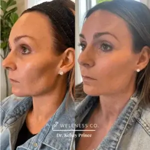 Before and After Photo | IPL, Neuromodulator, Sculptra | Wellness Co. | Zeeland, MI