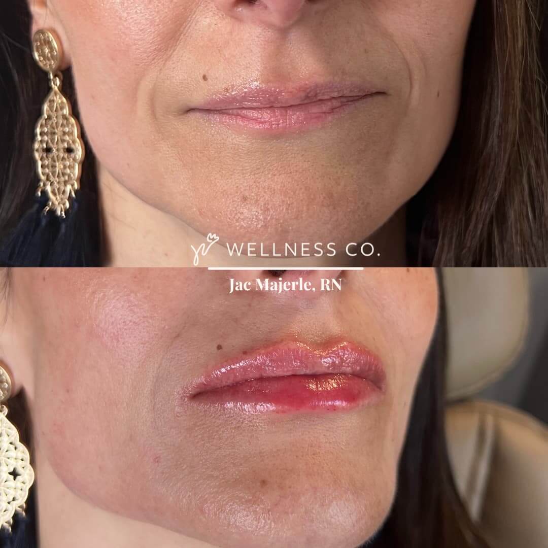 Before and After Photo | Filler treatment for lips | Wellness Co. | Zeeland, MI