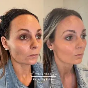 Before and After Photo | Botox, Dysport | Wellness Co. | Zeeland, MI