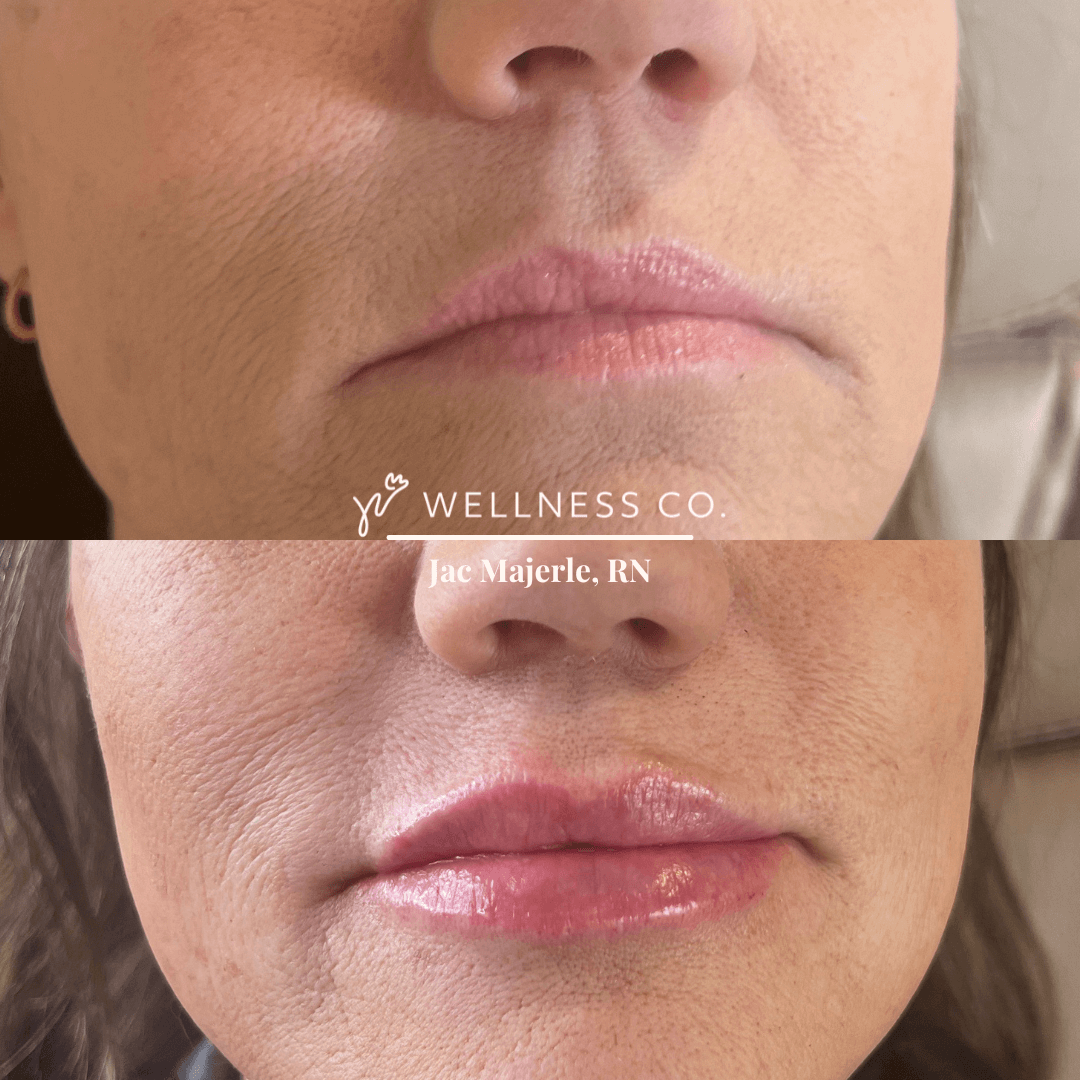 Before and After Photo | Filler treatment of woman | Wellness Co. | Zeeland, MI