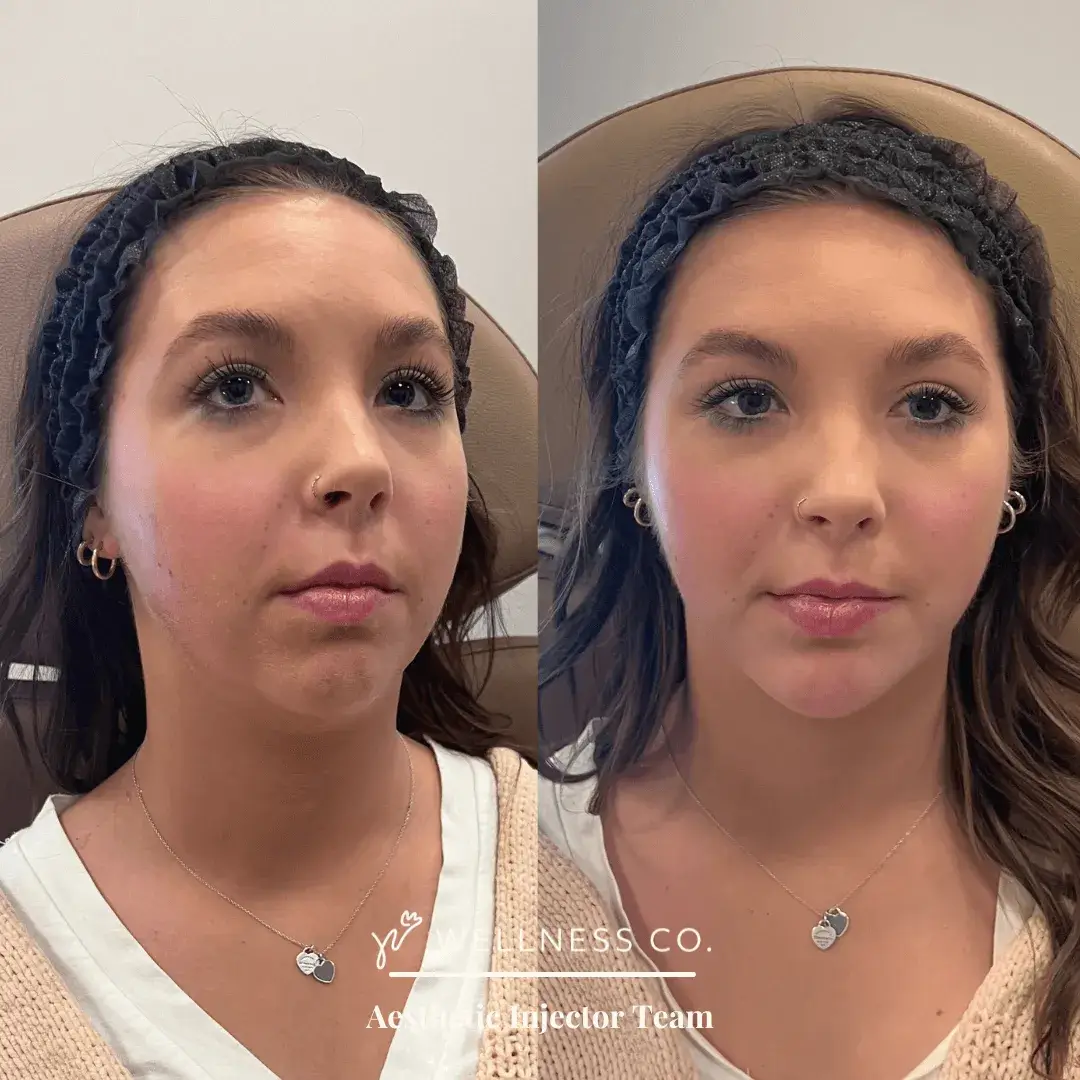 Before and after Photo | Dermal Filler for Facial features | Wellness Co. | Zeeland, MI