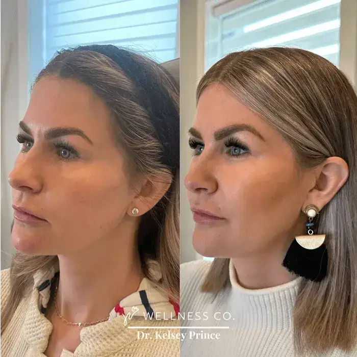 Before and after Photo | Dermal Filler for Full face | woman left side pose | Wellness Co. | Zeeland, MI
