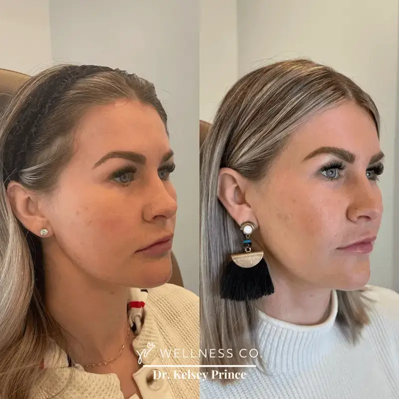 Before and after Photo | Dermal Filler for Full face | woman side pose | Wellness Co. | Zeeland, MI