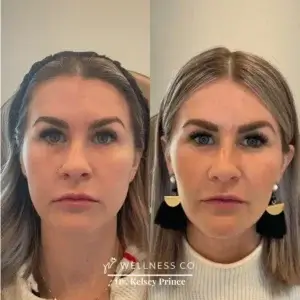 Before and after Photo | Dermal Filler for Full face | woman face | Wellness Co. | Zeeland, MI