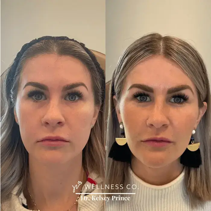 Before and after Photo | Dermal Filler for Full face | woman face | Wellness Co. | Zeeland, MI