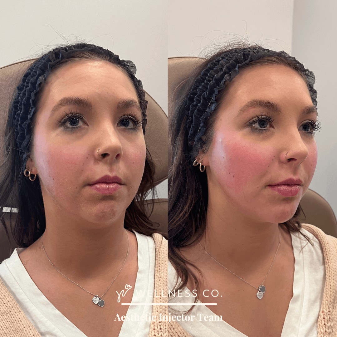 Before and after Photo | Dermal Filler treatment for full face | Wellness Co. | Zeeland, MI