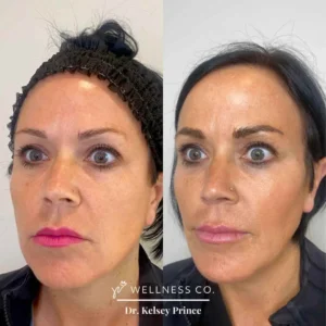 Before and after Photo | Sculptra treatment | Wellness Co. | Zeeland, MI