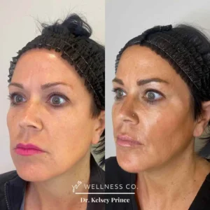 Before and after Photo | Sculptra for face | Wellness Co. | Zeeland, MI