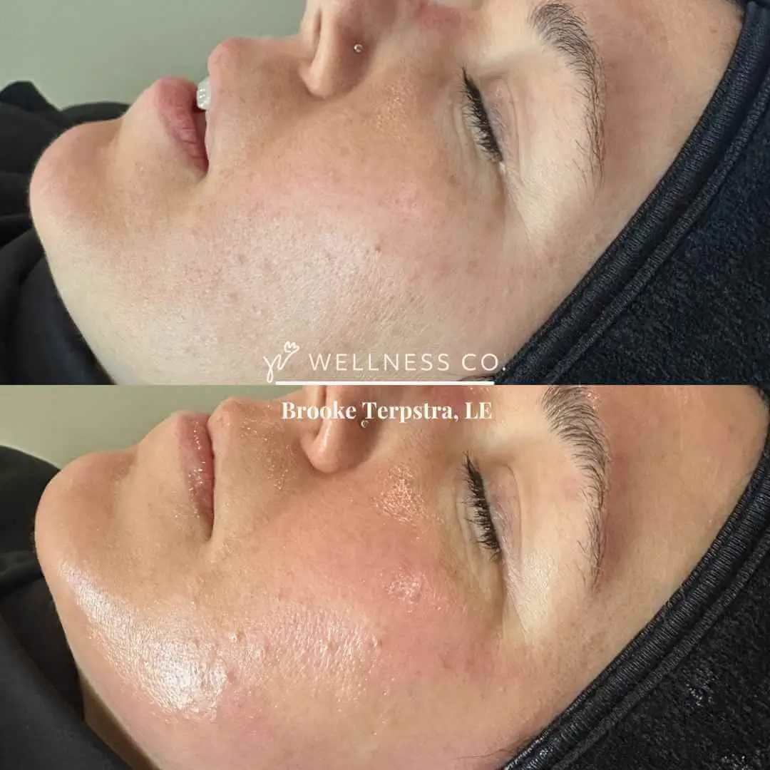 Before and after Photo | Facial HydraFacial treatment | Wellness Co. | Zeeland, MI