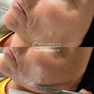 Before and after Photo | Dermaplaning for facial lines | Wellness Co. | Zeeland, MI