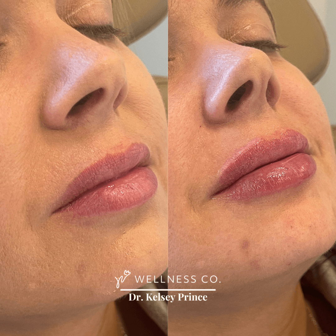 Before and after Photo | Dermal Filler | volume and fuller lips | Wellness Co. | Zeeland, MI