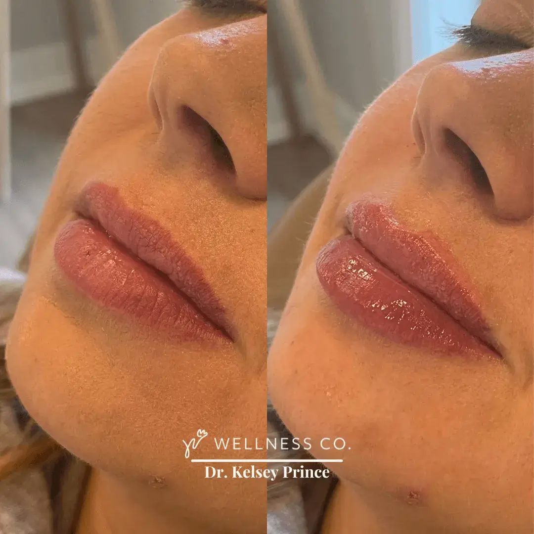 Before and after Photo | Dermal Filler for voluminous lips | Wellness Co. | Zeeland, MI
