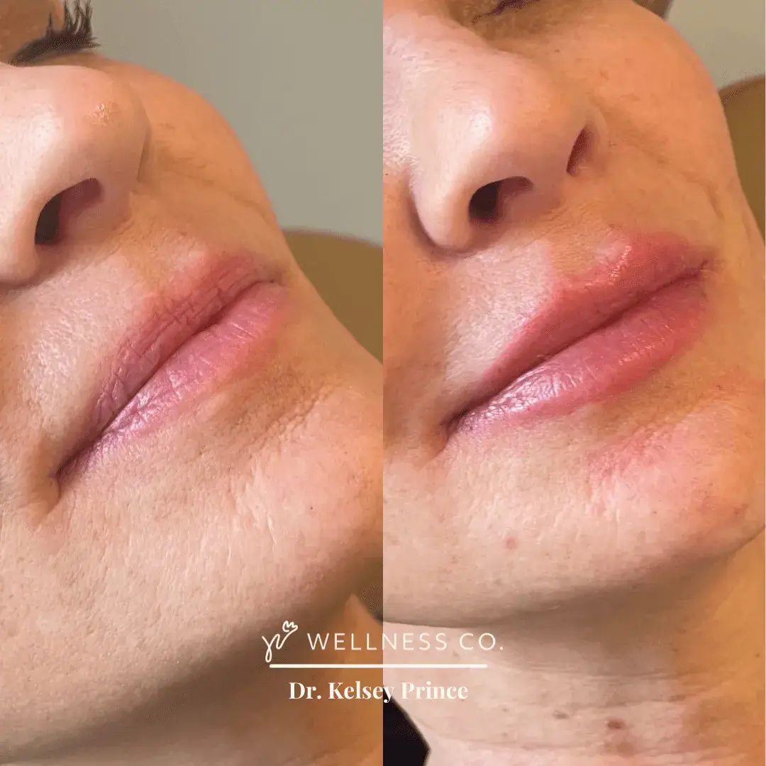 Before and after Photo | Dermal Filler for enhanced lips | Wellness Co. | Zeeland, MI