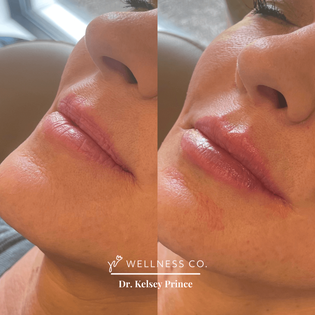 Before and after Photo | Dermal Filler for facial lines | Wellness Co. | Zeeland, MI