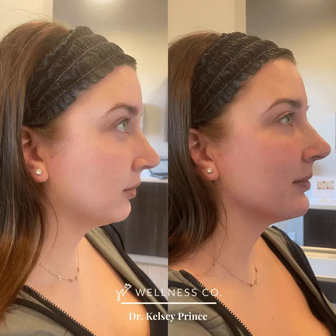 Before and after Photo | Dermal Filler for contoured jawline | Wellness Co. | Zeeland, MI