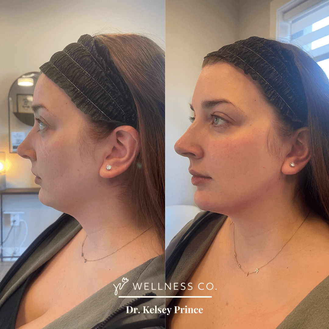 Before and after Photo | Dermal Filler for face symmetry | Wellness Co. | Zeeland, MI