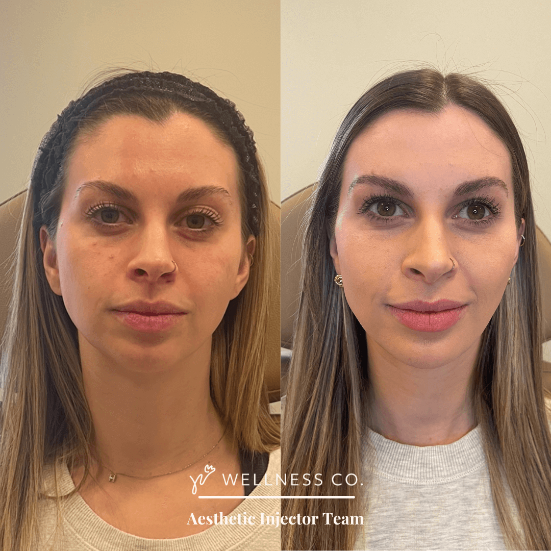 Dermal filler before after 2