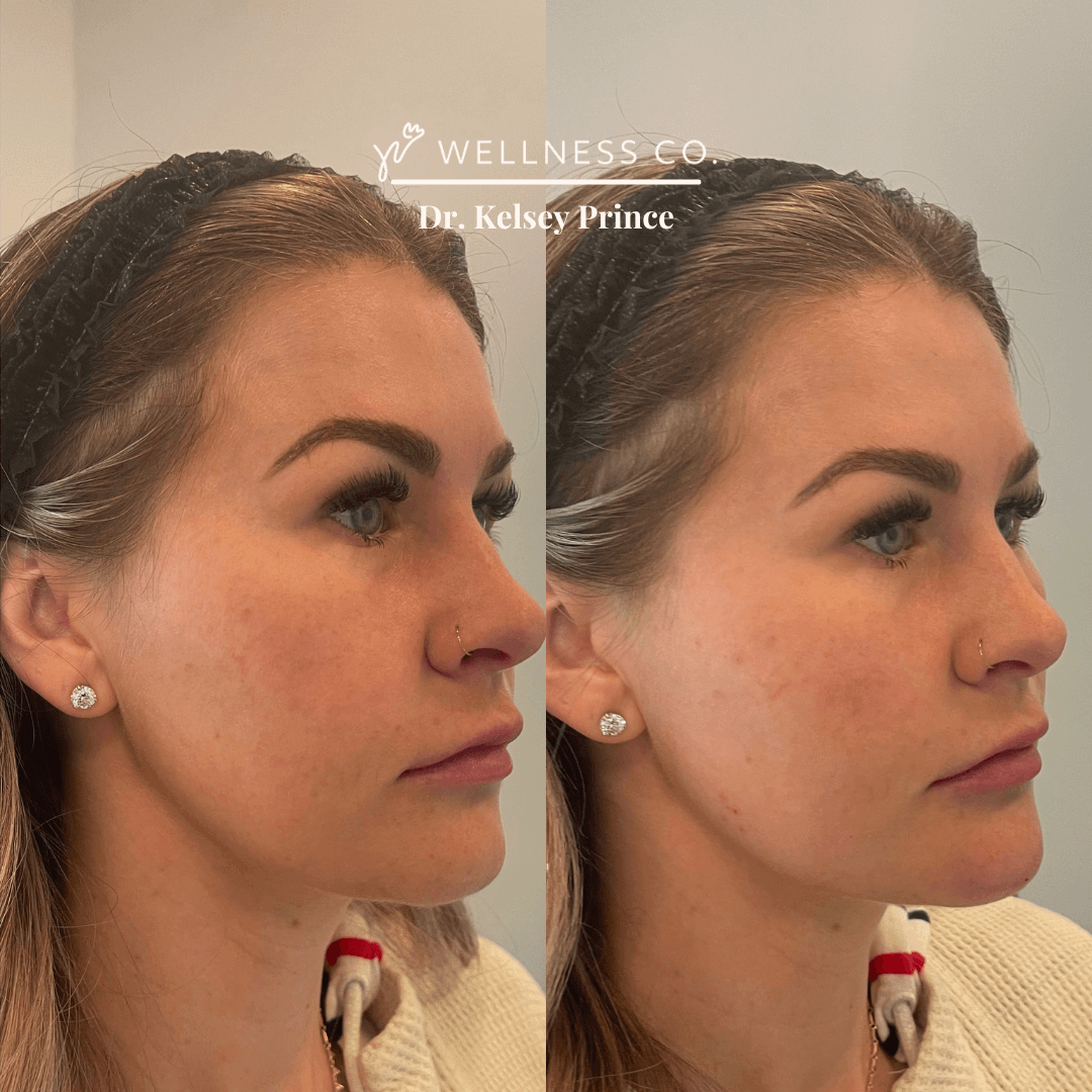 Dermal filler before after 4
