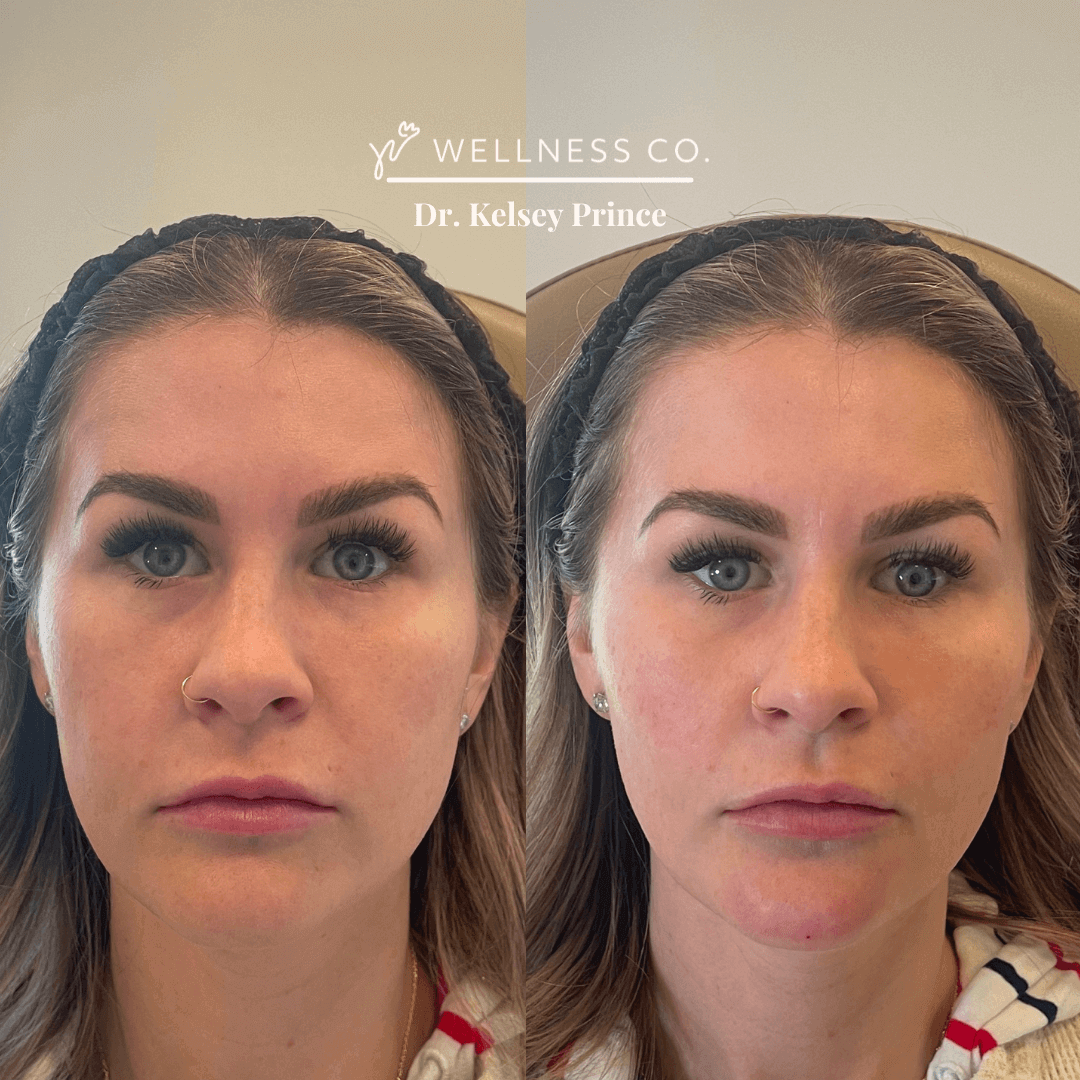 Dermal filler before after 5