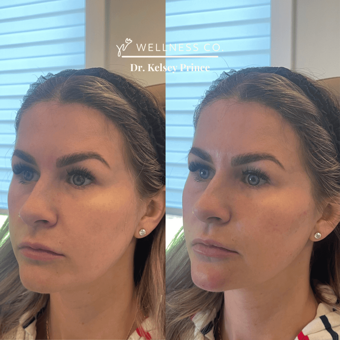 Dermal filler before after 6