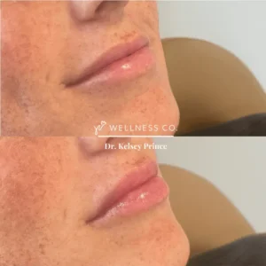 Before and after Photo | Lip filler treatment for fuller lips | Wellness Co. | Zeeland, MI