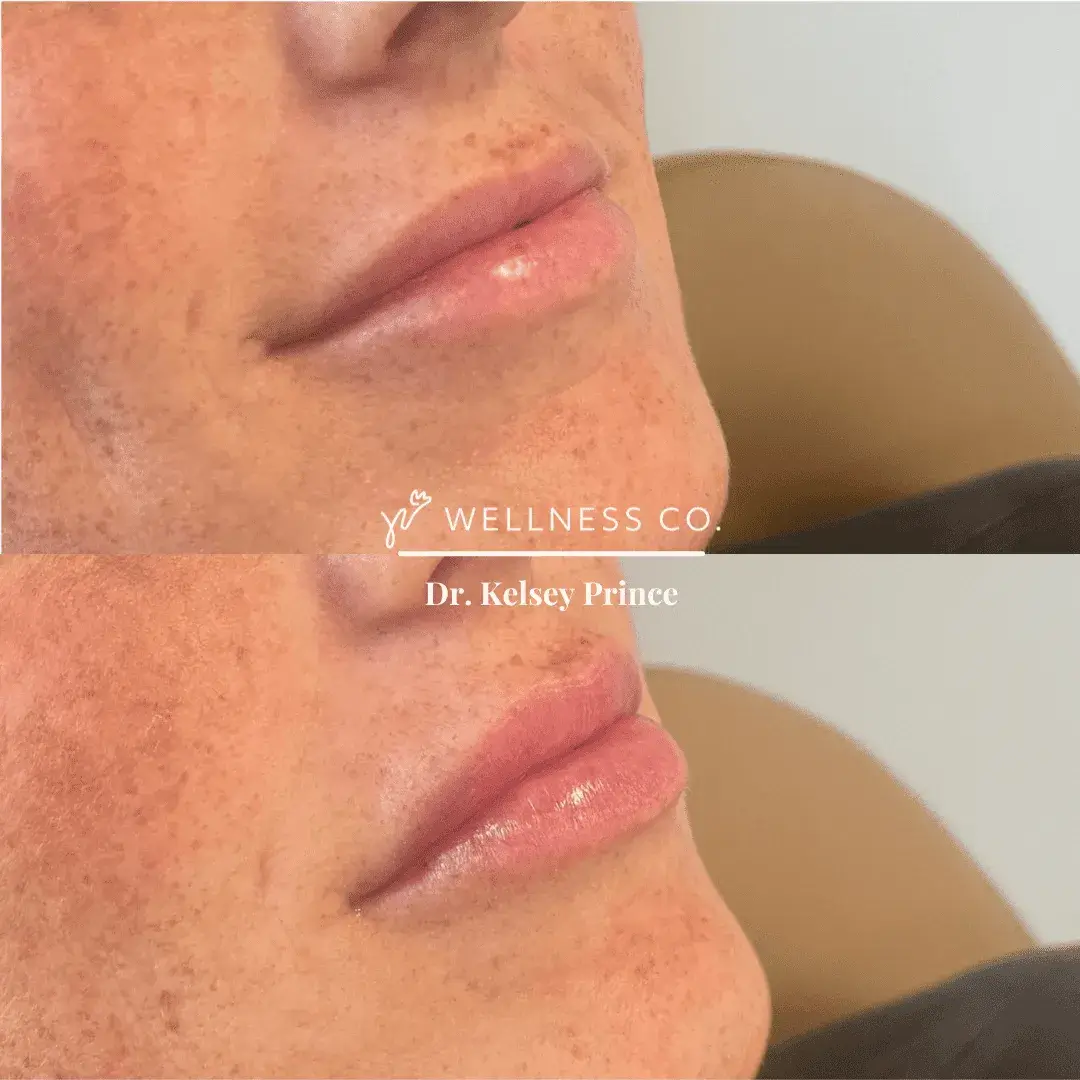 Before and after Photo | Lip filler treatment for fuller lips | Wellness Co. | Zeeland, MI