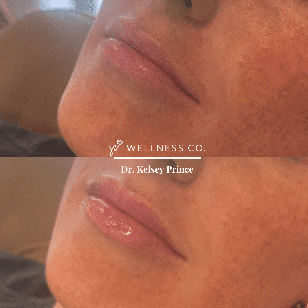 Before and after Photo | Lip Filler | close up | Wellness Co. | Zeeland, MI