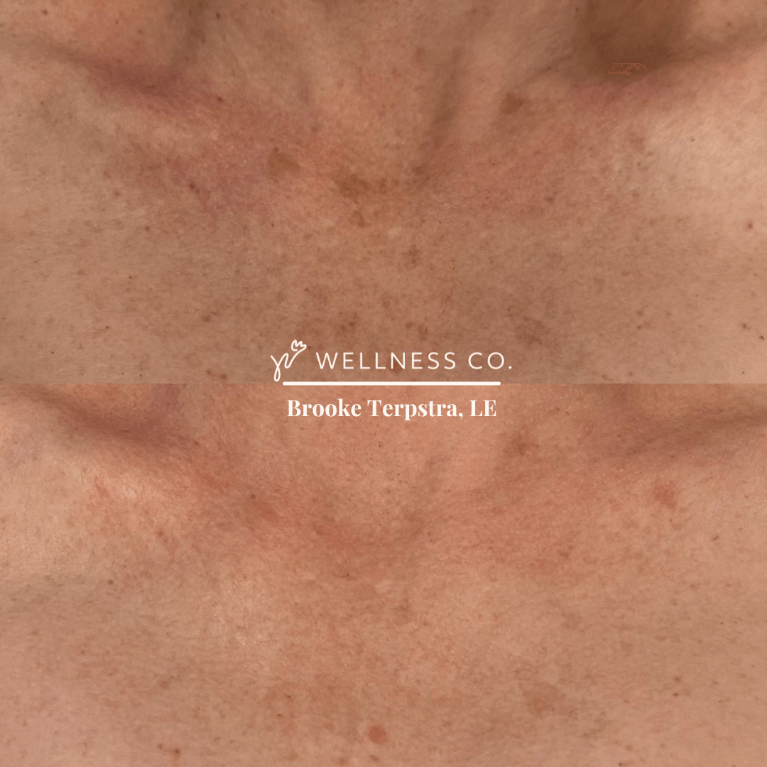 Before and After Photo | IPL Treatment on chest | Wellness Co. | Zeeland, MI