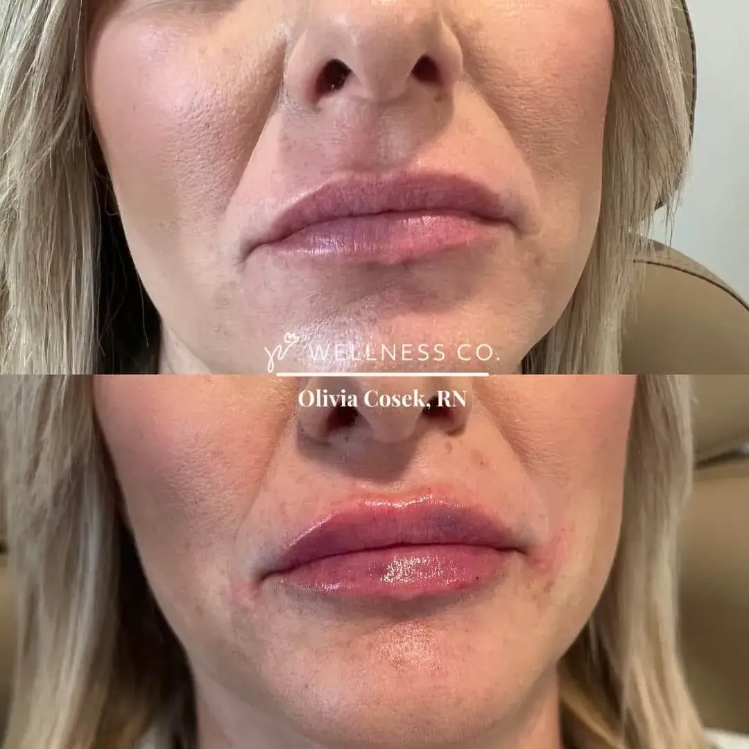 Before and after Photo | Lip Filler for lips of woman | Wellness Co. | Zeeland, MI