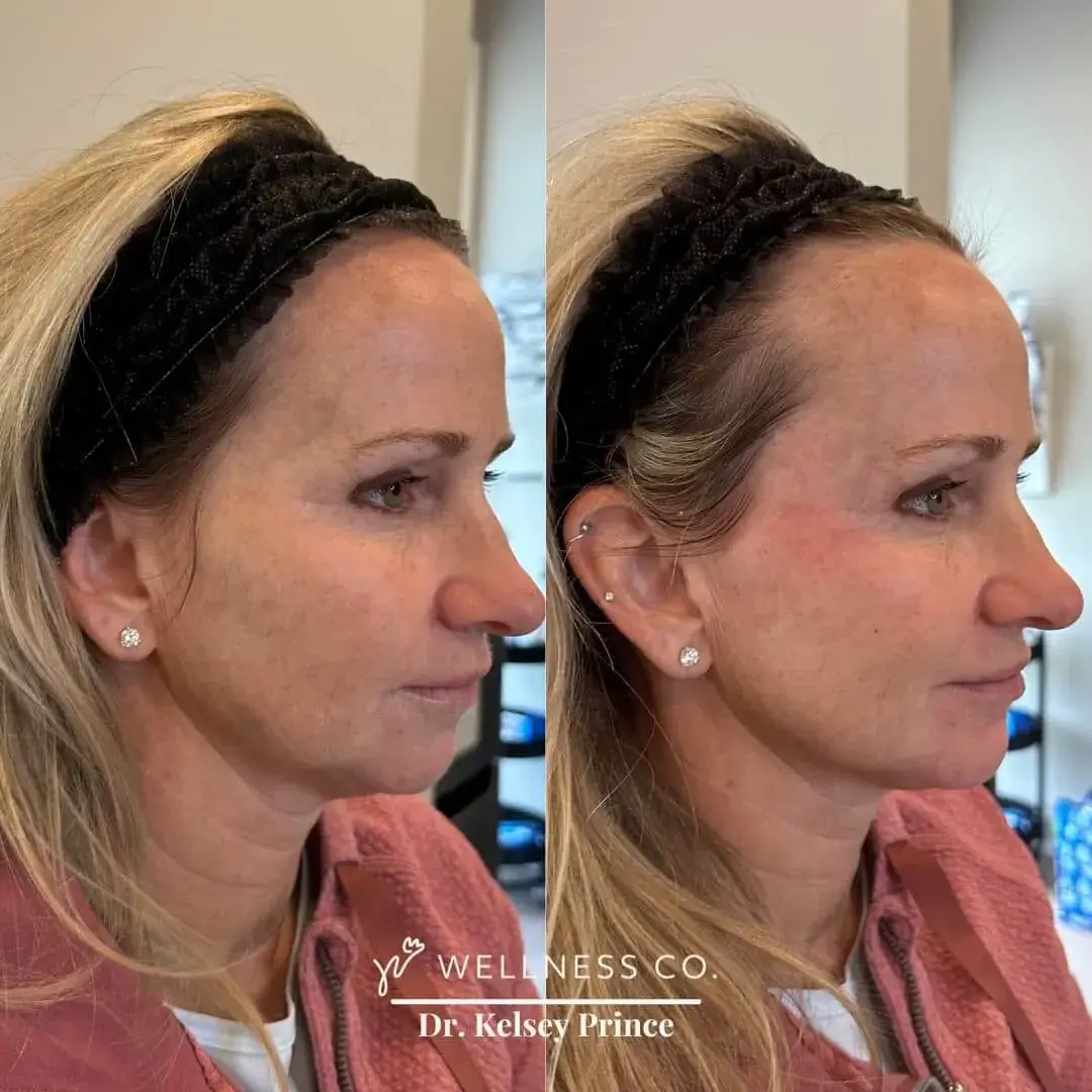 Before and after Photo | Dermal Filler | Full Face | side pose | Wellness Co. | Zeeland, MI