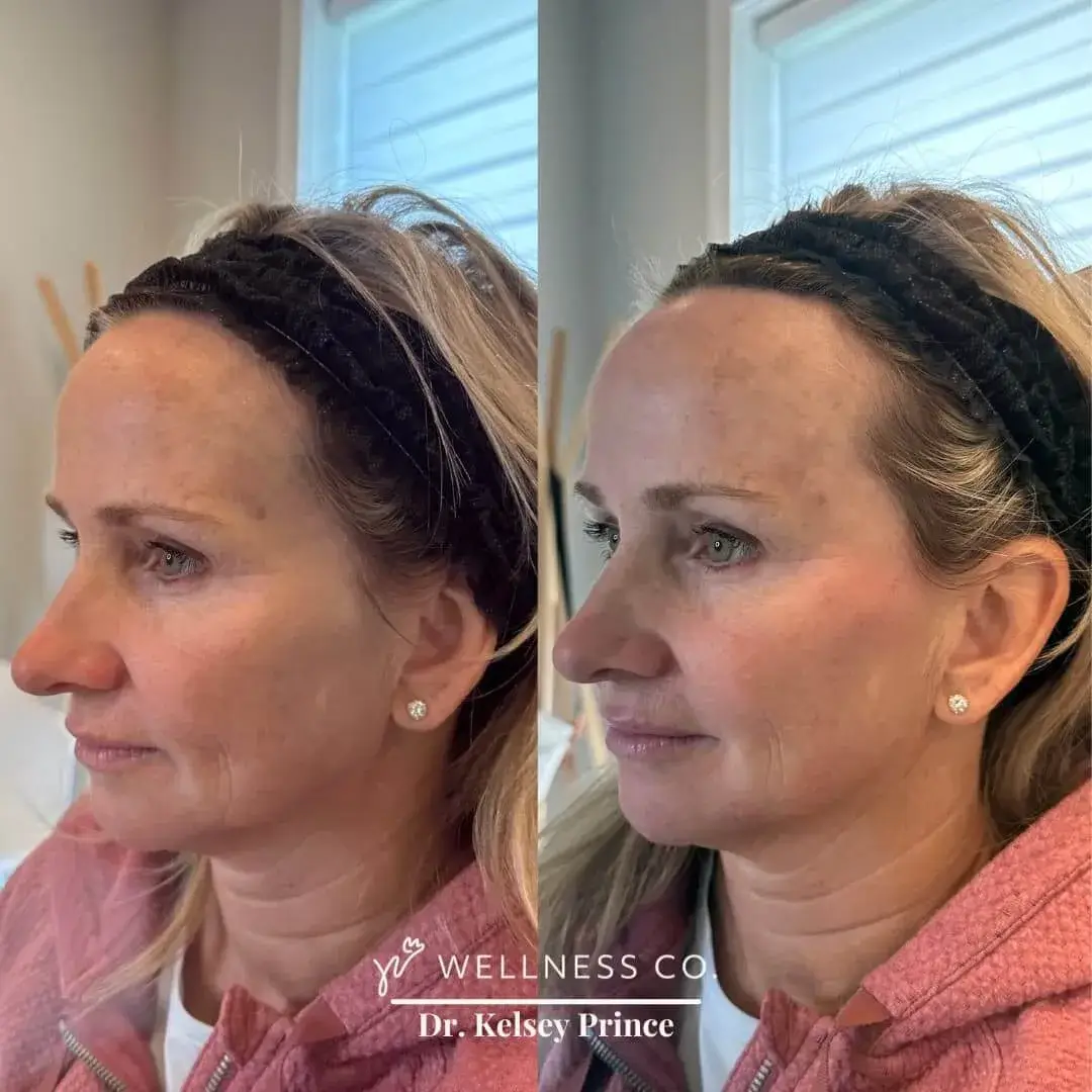 Before and after Photo | Dermal Filler | Full Face | right side pose | Wellness Co. | Zeeland, MI