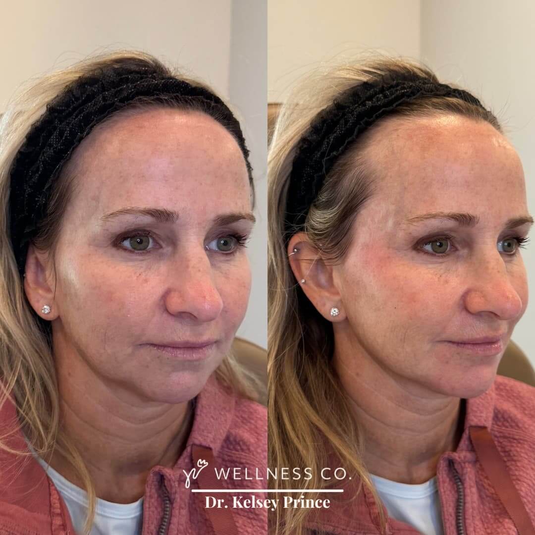 Before and after Photo | Dermal Filler | Full Face | left side pose | Wellness Co. | Zeeland, MI